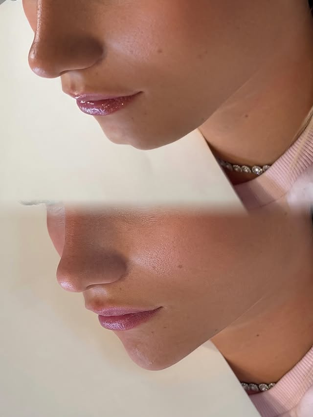 Chin filler – before and after