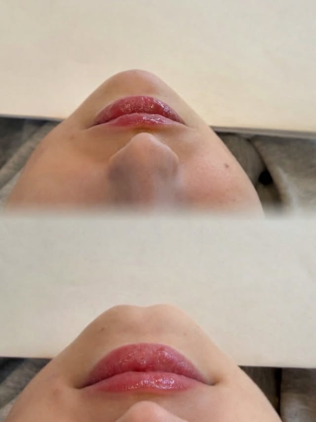 Chin filler – before and after