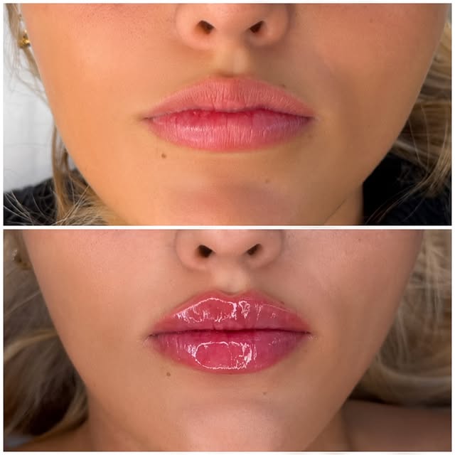 Russian Lips lip enhancement – before and after