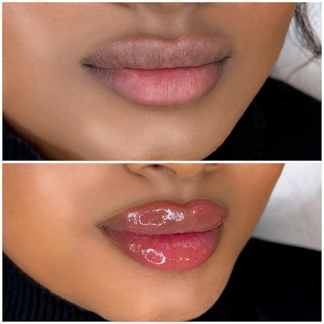 Russian Lips lip enhancement – before and after