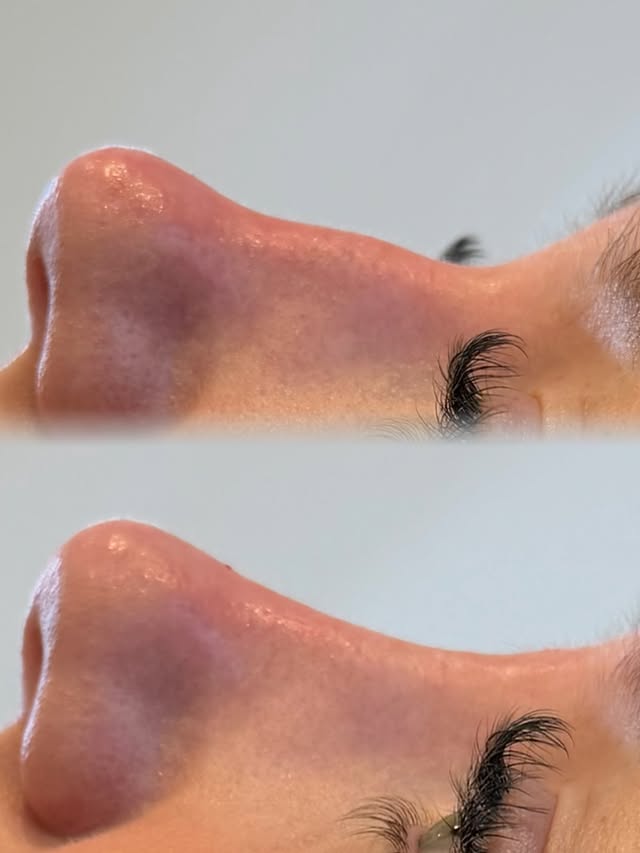 Nose correction with filler – before and after