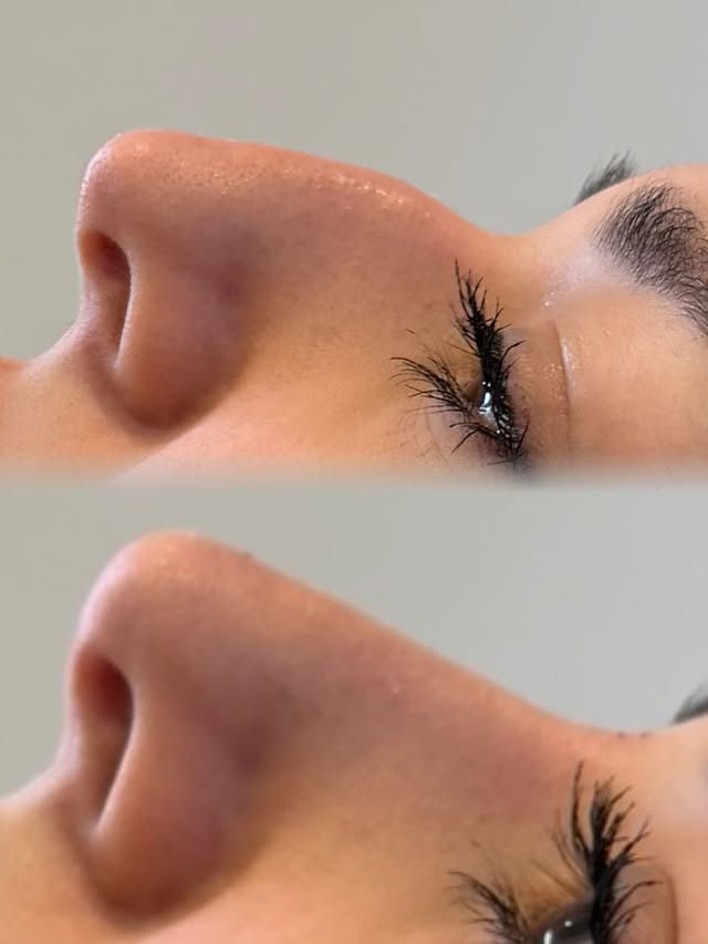 Nose correction with filler – before and after