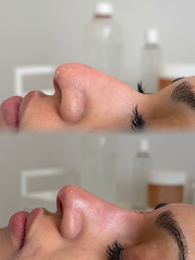 Nose correction with filler – before and after