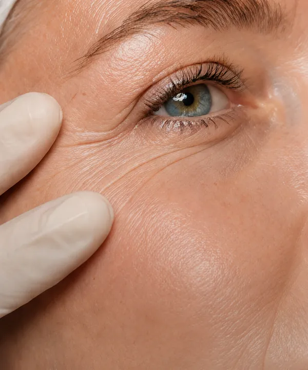 Close-up of skin around the eye before a wrinkle treatment